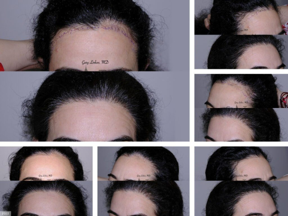 Linkov Hair Surgery