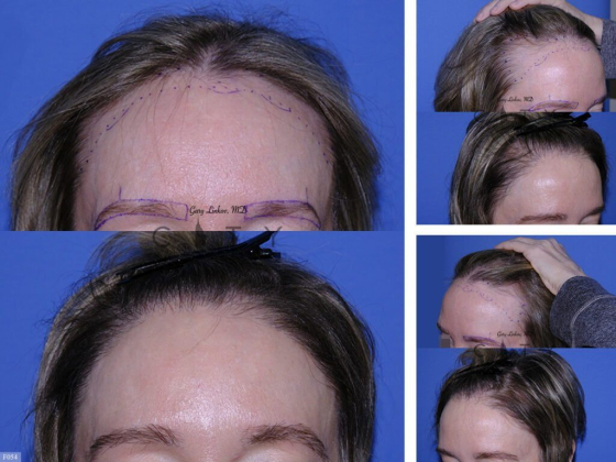 Hair Loss Treatments for Women in NYC