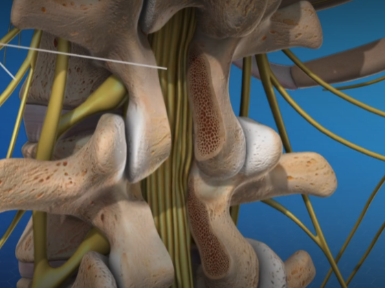 Revision Surgery in Hackensack, NJ