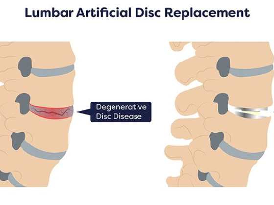 Disc Replacement Surgery in Hackensack, NJ