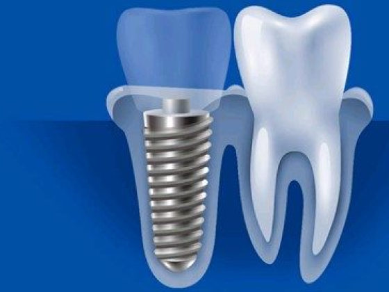 Get Your Tooth Replaced With Cheap Dental Implants Sydney!