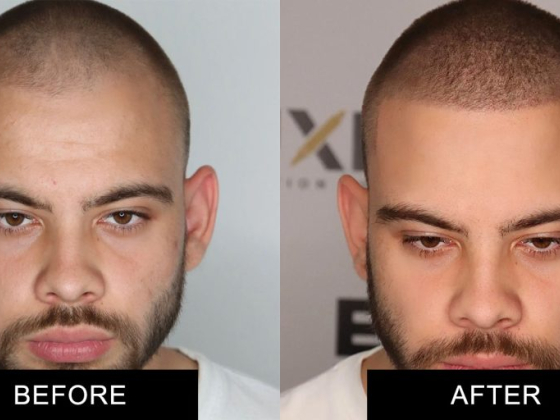 Elixir Pigmentation