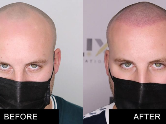 Elixir Pigmentation