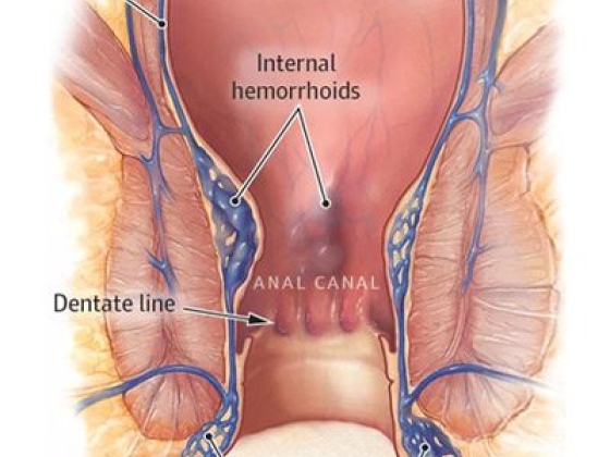 Laser Hemorrhoid Treatment in New York, NY