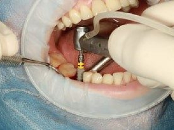 Tips to get the best Dental Implant to flaunt a Happy Smile