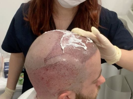 Capital Hair Restoration - Hair Transplant
