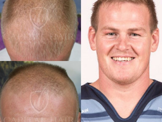 Capital Hair Restoration - Hair Transplant