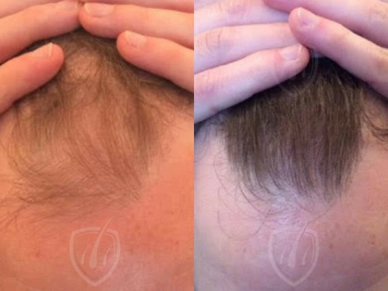 Capital Hair Restoration - Hair Transplant