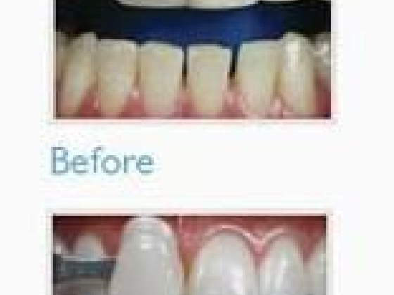 Teeth Whitening South Yarra