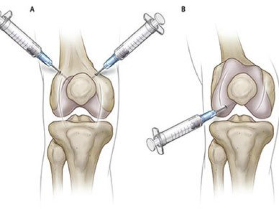 Knee Injections for Osteoarthritis in NYC