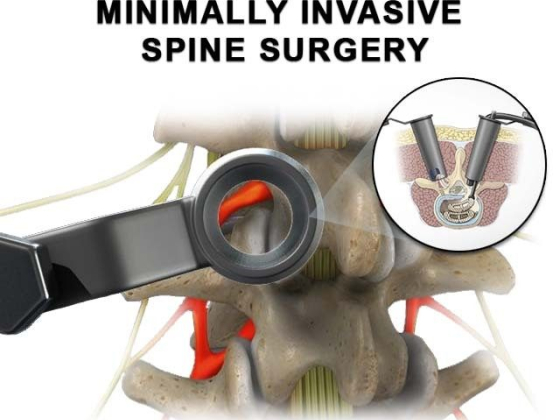 Minimally Invasive Spine Surgery in NYC