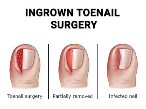 Ingrown Toenail Treatments in NJ