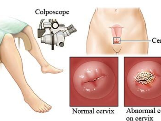 Colposcopy Procedure in Brooklyn
