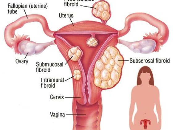 Uterine Fibroid Treatment in Brooklyn