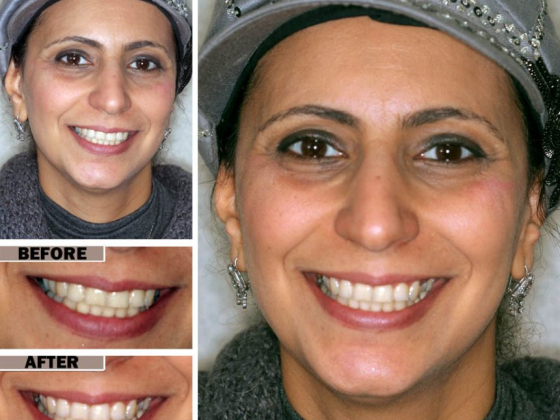 Teeth Cleaning in Brooklyn