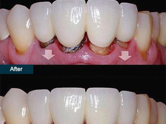 Dental Bridges in Brooklyn