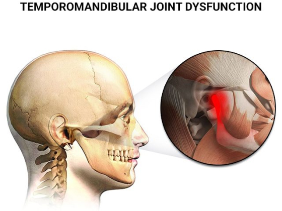 TMJ Treatment in Astoria NY