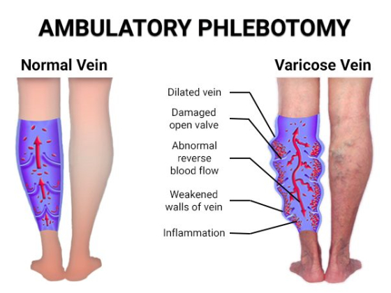 Ambulatory Phlebotomy in Brooklyn