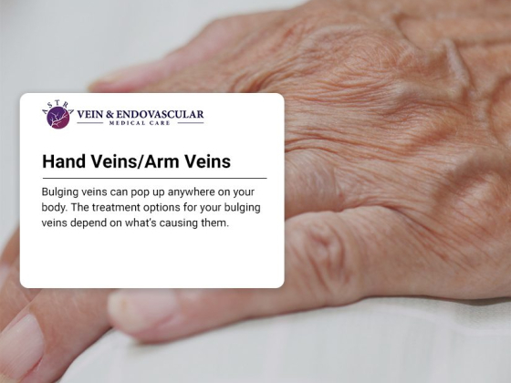 Hand Vein Treatment in Brooklyn