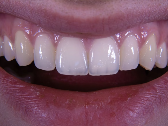 Dental Implants After Chemotherapy - Is It an Option?