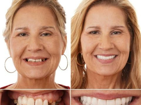 Louisiana Implants and Dentures