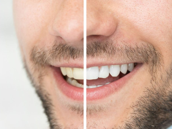 Smile Brighter Instantly: Visit the Top Teeth Whitening Dental Clinic in Hubli