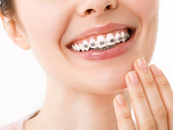 Top-Rated Orthodontist in Andheri for Braces & Aligners