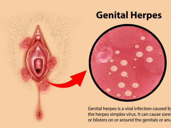 Diagram showing genital herpes infection and detailed blister view